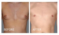 Local Business The Gynecomastia Surgery Center Philippines in Makati NCR