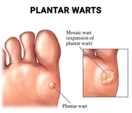 Plantar Warts