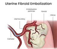 Uterine Fibroid Embolization (UFE) in Downtown Brooklyn, NY