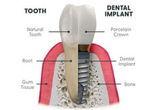 Dental Implants in Yonkers