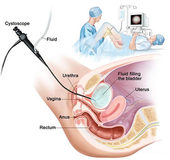 Cystoscopy Procedure