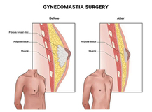 Gynecomastia Surgery In New Jersey
