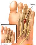 Neuroma Surgery in NYC