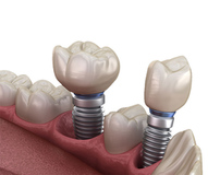 Dental Implants in Rockville