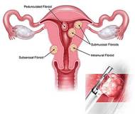 Myosure Fibroid and Polyp Removal Procedure