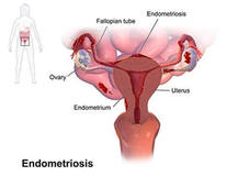 Endometriosis - OB/GYN Physicians Brooklyn Heights, NYC