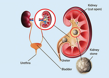Kidney Stone Treatment In Bhosari |  Swanand Kidney Clinic
