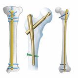 Experienced Orthopedic Instrument Companies