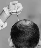 Are You Looking For Best Hair Transplant in the UK