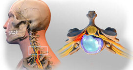 Herniated Disc in the Neck Treatment in NYC | Neck Pain Doctors Specialists