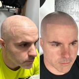 Hair Replacement For Men