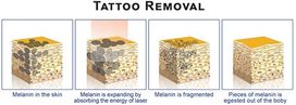 Tattoo Removal