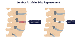 DISC REPLACEMENT SURGERY