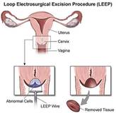 Loop Electrosurgical Excision Procedure
