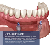 Denture Implants in Manhattan, NY