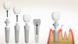 McIntosh Dental - Dental Implants Auckland
