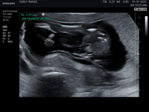 Trust Early Image for Safe, Accurate, and Non-Invasive Gender Scan Determination