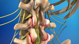 Post-Laminectomy Syndrome Treatment NYC | Back Pain Doctors