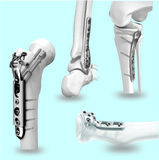 Orthopedic Instruments Manufacturers
