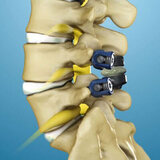 Spinal Stenosis Surgery in NYC | Spine Doctors Specialists in New York