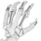 Orthopedic Implants Manufacturers in India